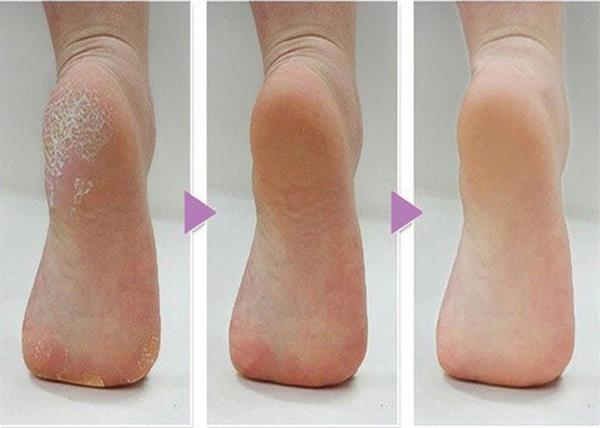 home remedies for cracked heels in Hindi.jpg